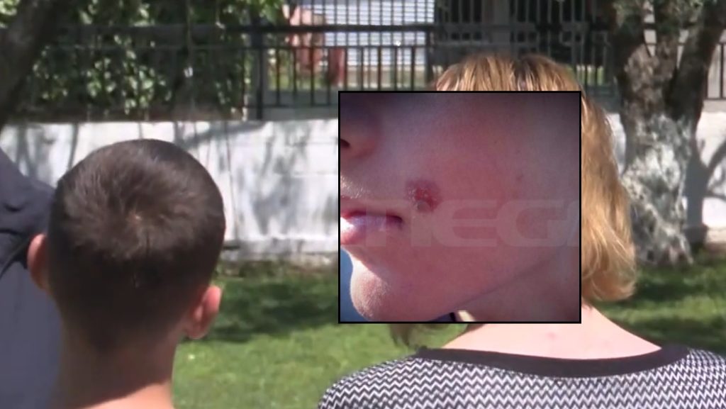 Πέλλα: Σοκαριστικό περιστατικό bullying – Έσβηναν τσιγάρα στο μάγουλο 14χρονου, προσπάθησαν να τον πνίξουν με ζακέτα (Video)