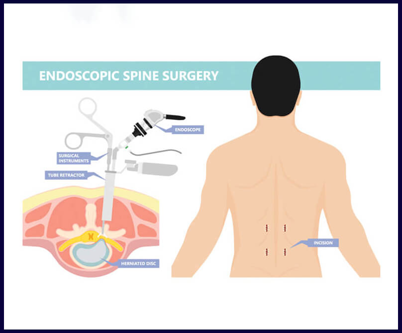 Ενδοσκοπική χειρουργική σπονδυλικής στήλης